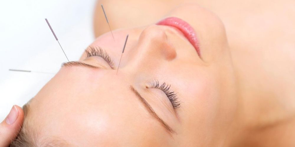 Лечение мигрени иглоукалыванием